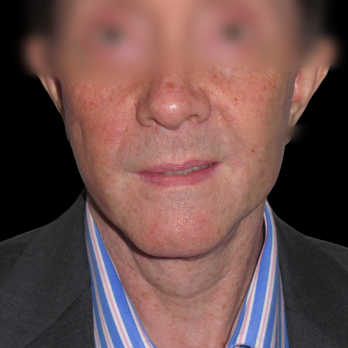 male-facelift-after